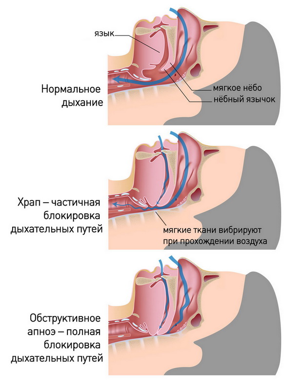 Анатомия храпа и апноэ